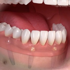 All on 4 Dental Implants